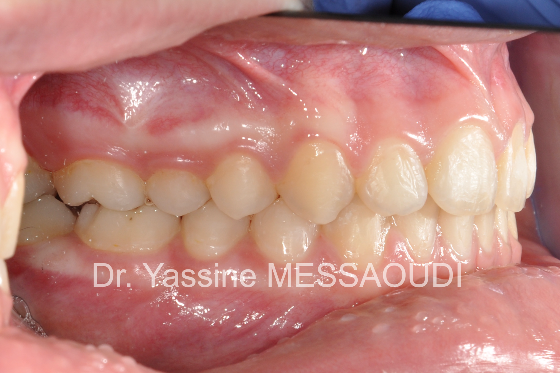 Classe II - Après traitement